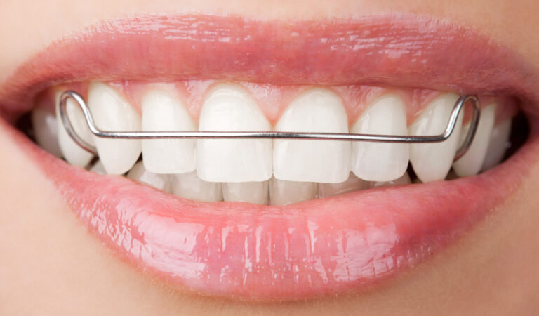 Orthodontic Retainers: Types, Cost, Pros and Cons, Care