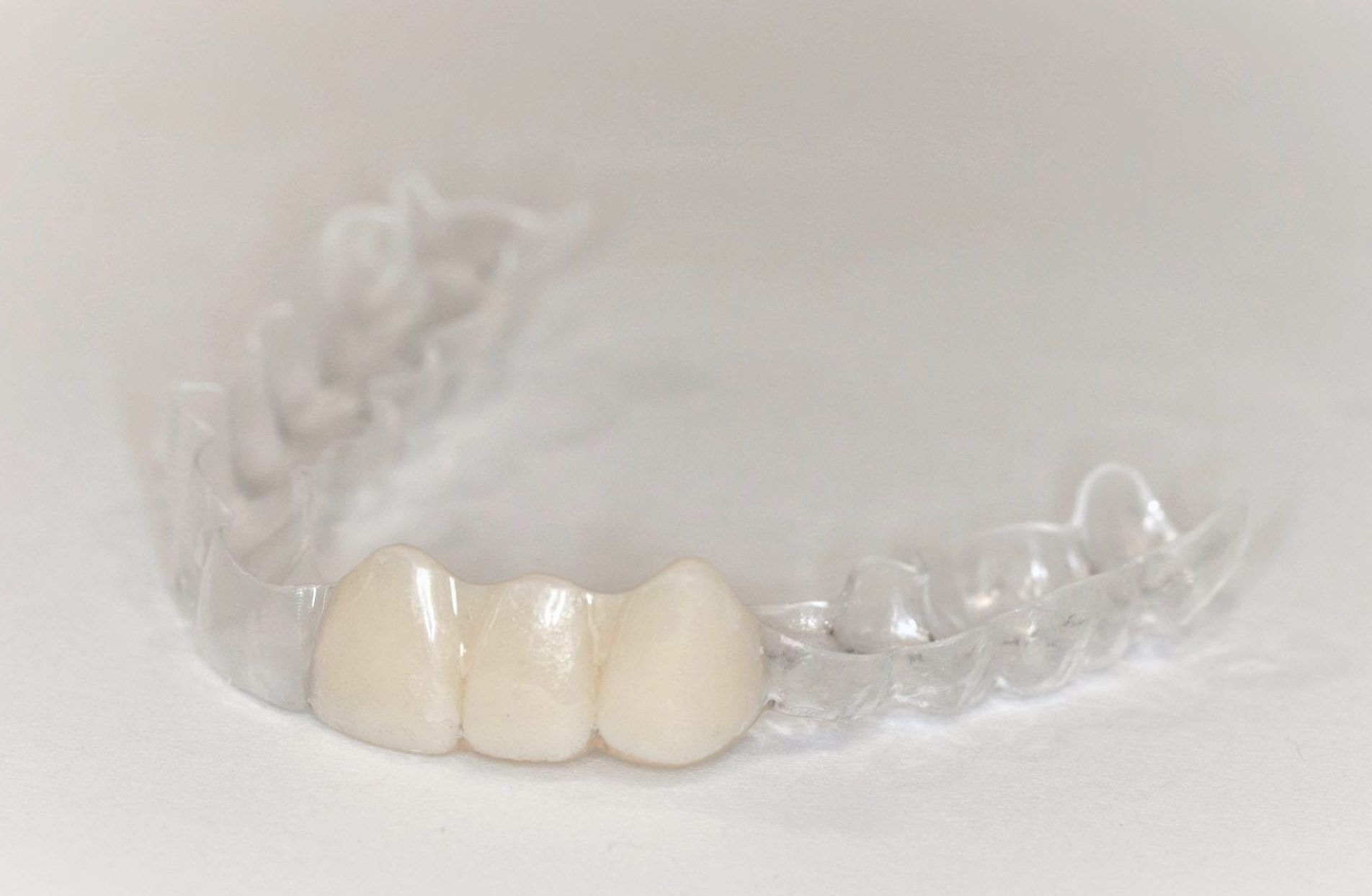 Essix Partial Denture Retainer