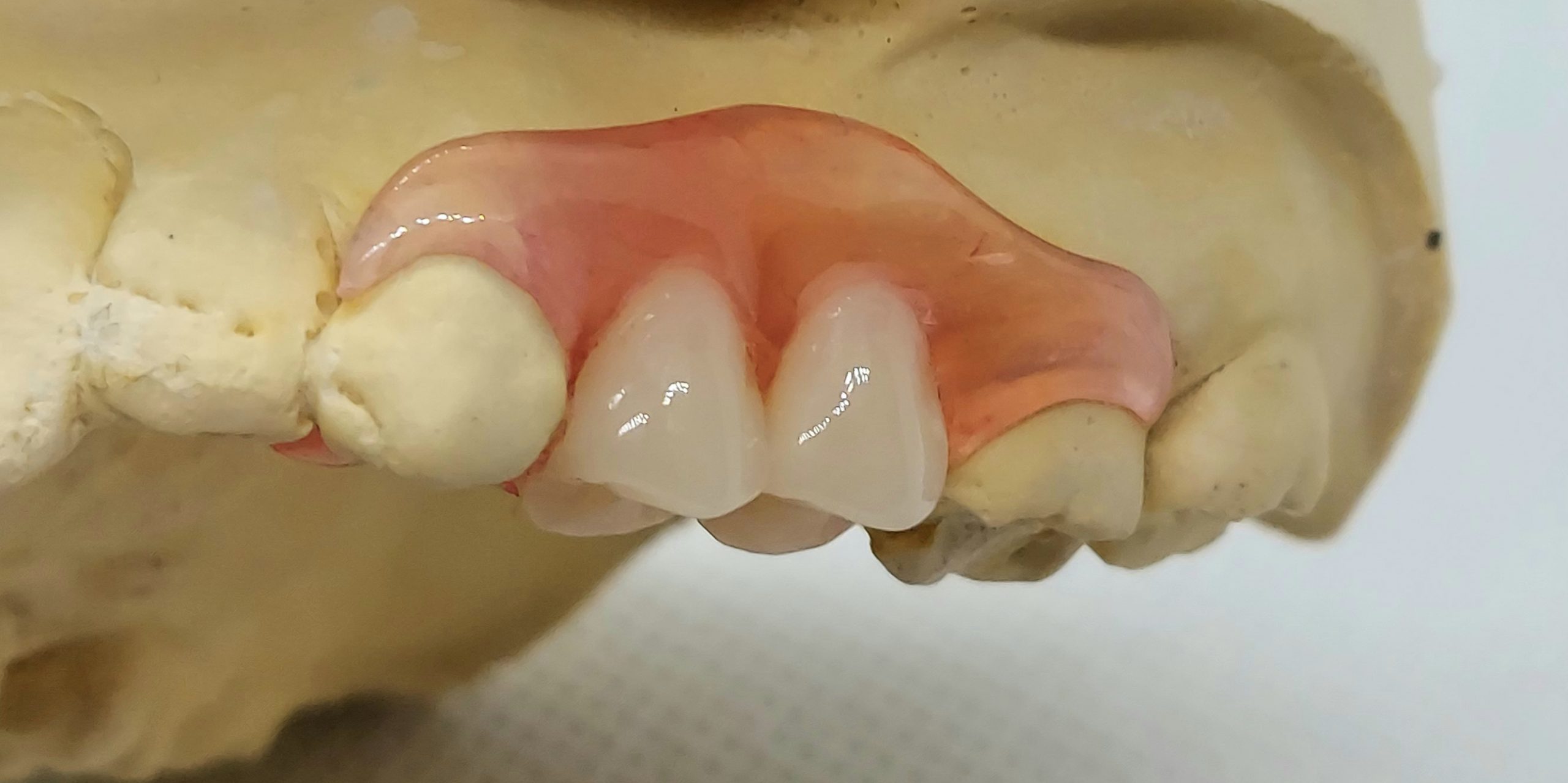 Nesbit Flexible Partial Denture