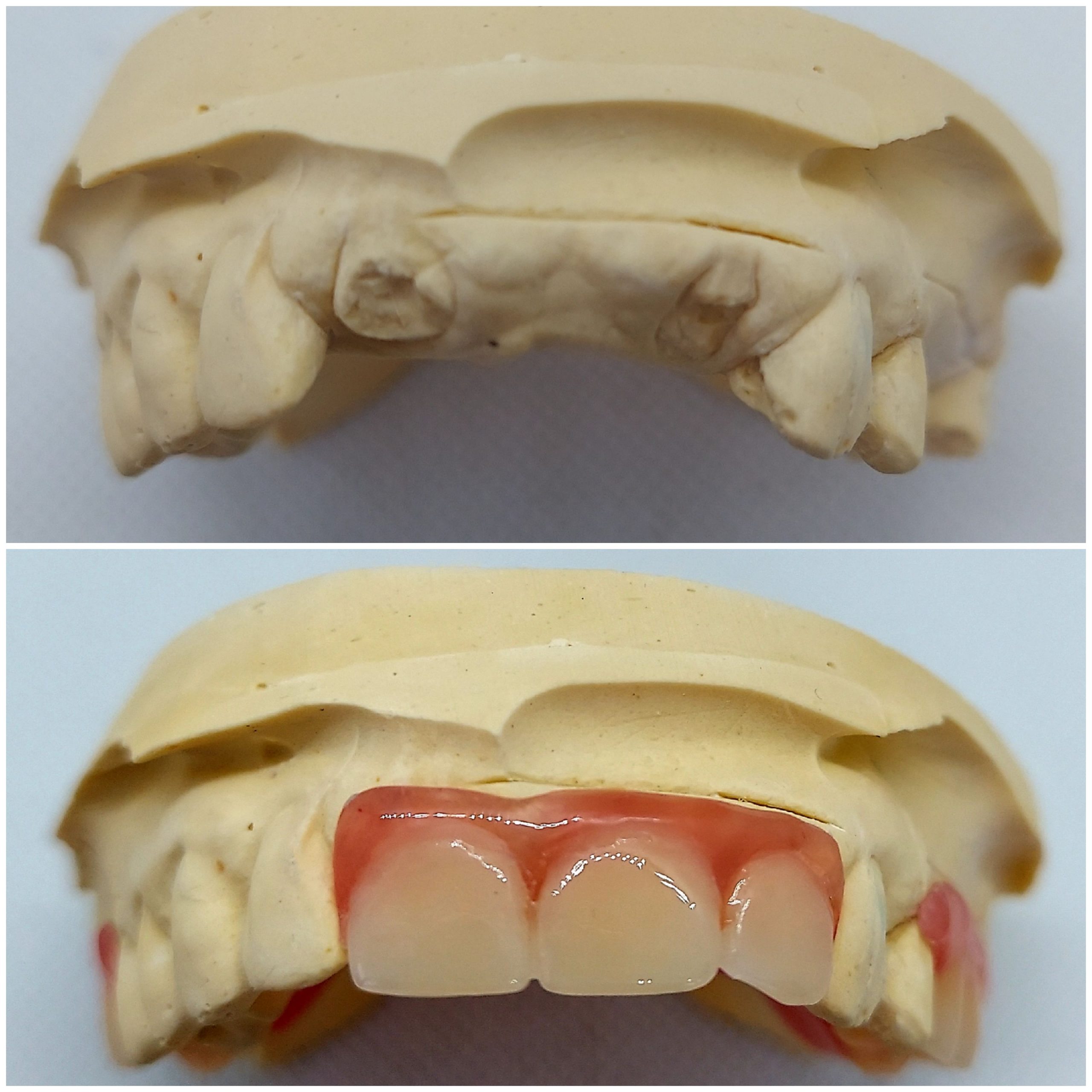 Flexible Partial Dentures