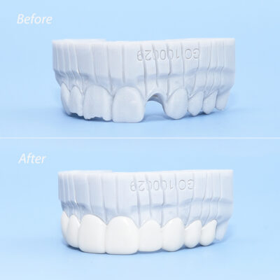 Vida Veneers Custom-Made Snap-On Veneers