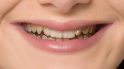 Vida Veneers Custom-Made Snap-On Veneers