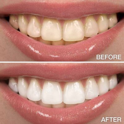 Vida Professional Teeth Whitening Kit