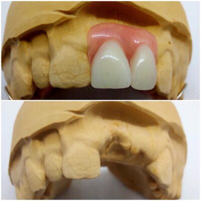 Acrylic Partial Denture Flipper