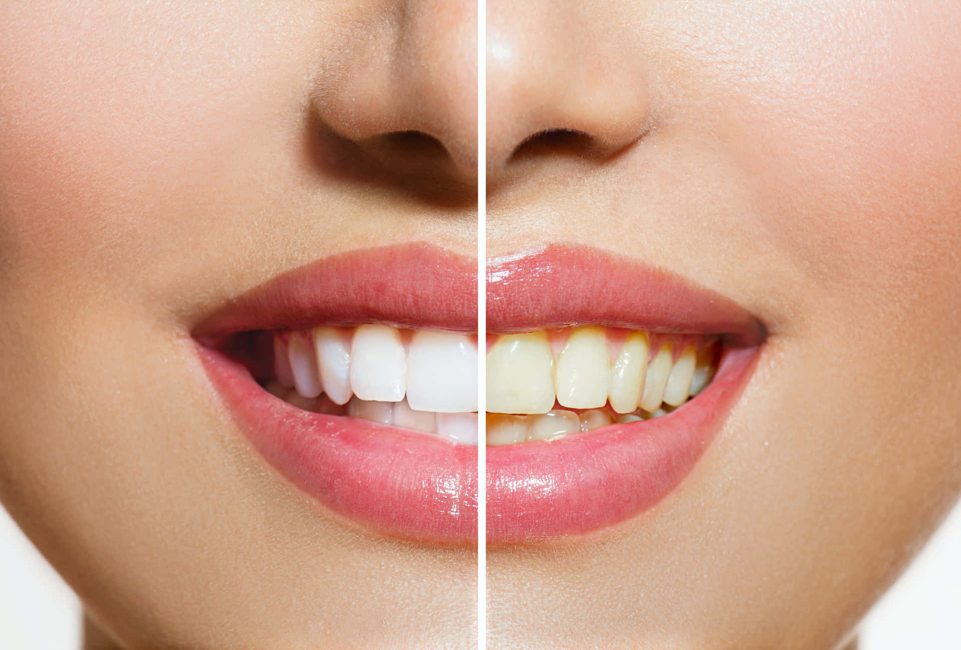 How to Choose the Right Teeth Whitening Kit for Your Smile?